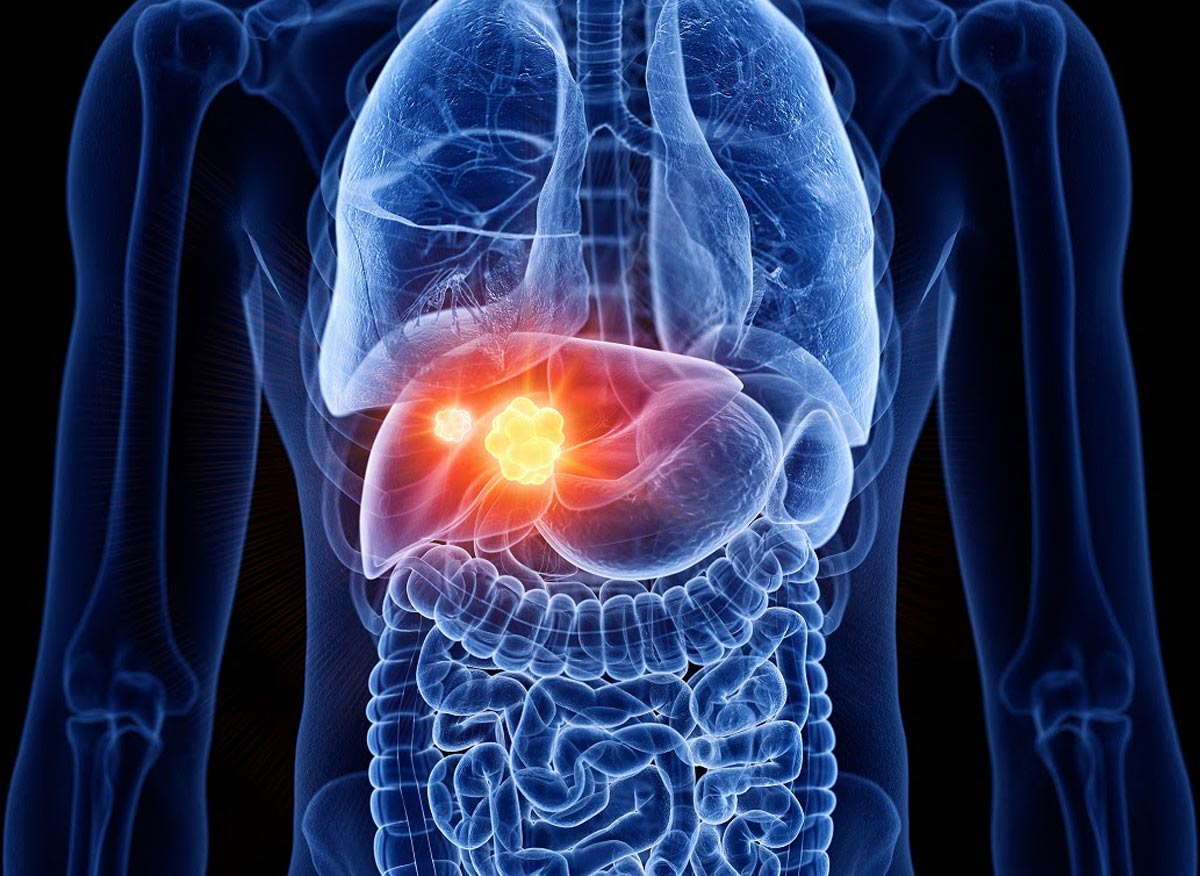 30 de Octubre: Día del cáncer de Hígado