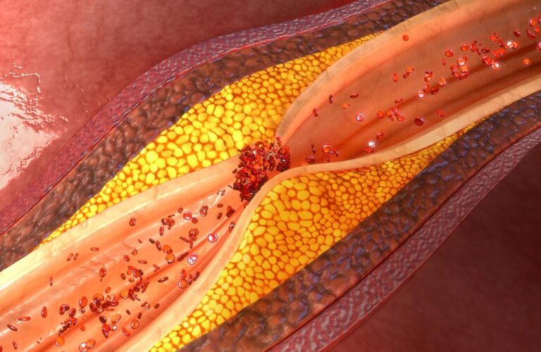 ¿Se puede revertir la enfermedad de las arterias coronarias?